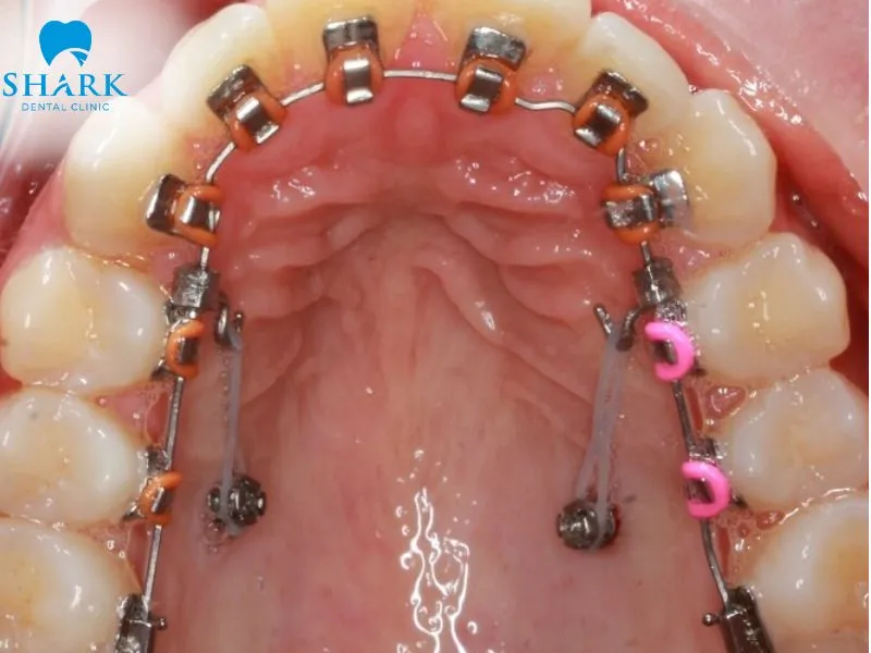 Orthodontic treatment helps correct bite alignment and tooth position, making it suitable for patients with moderate to severe dental misalignment
