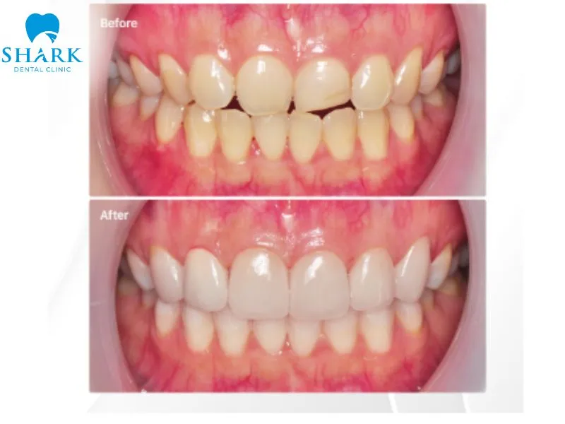 The severity and width of the gaps between the teeth are important factors in determining whether porcelain veneer treatment is appropriate