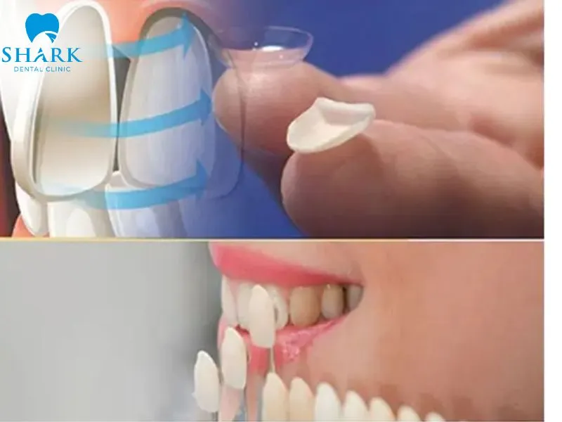 Composite resin can effectively cover visible gaps between spaced teeth, but it generally provides lower durability than porcelain veneers