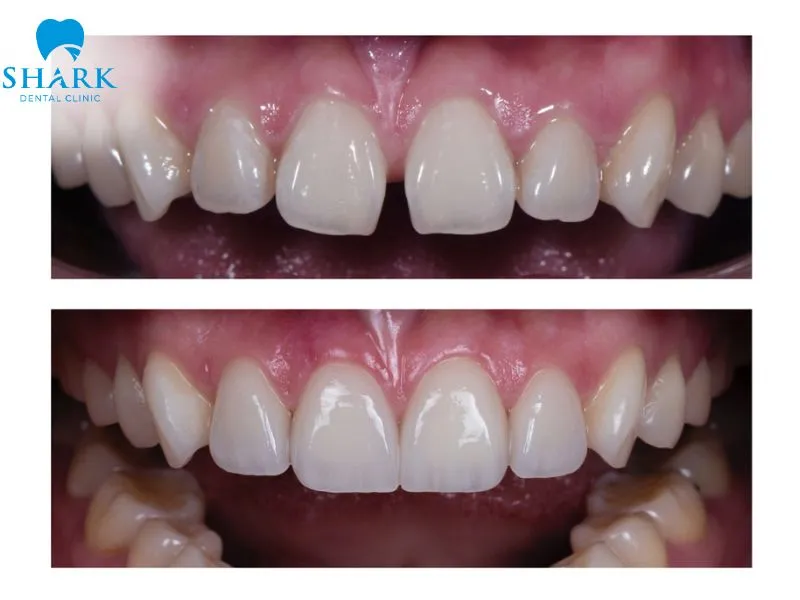 Porcelain veneers provide a harmonious combination of attractive aesthetics, reliable durability, and preservation of the natural tooth structure