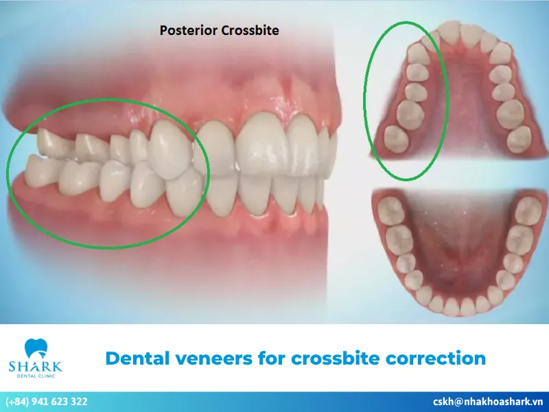 Dental veneers for crossbite correction: Effectiveness & steps