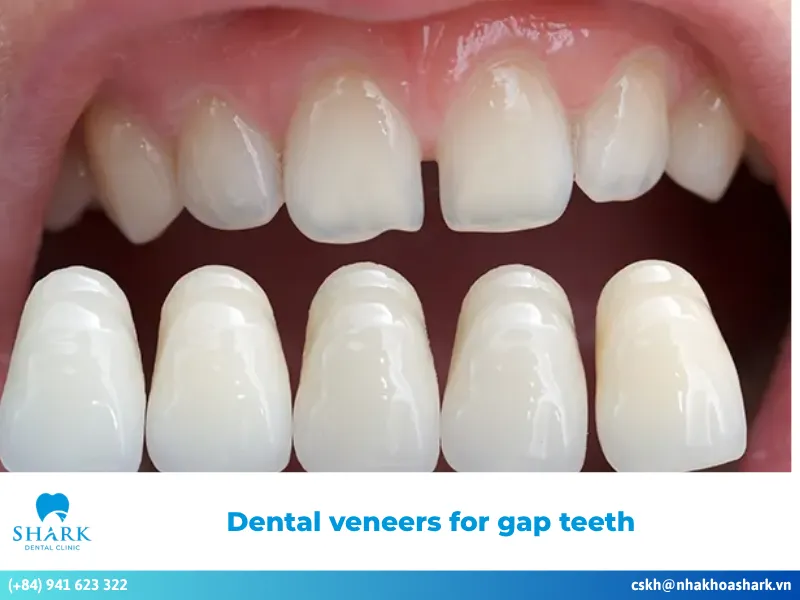 Dental veneers for gap teeth: Benefits, pros, cons & costs
