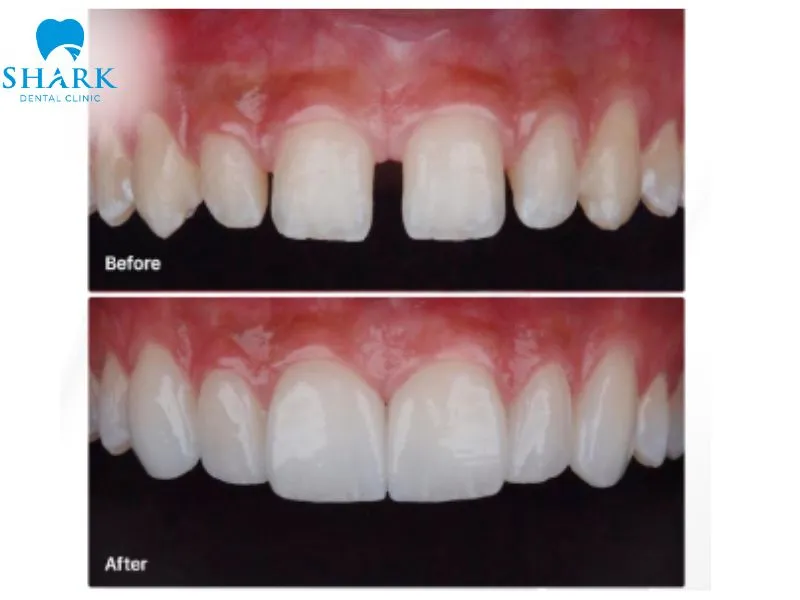 Porcelain veneers help cover visible spaces between gapped teeth, creating a smile that appears more balanced, harmonious, and naturally attractive