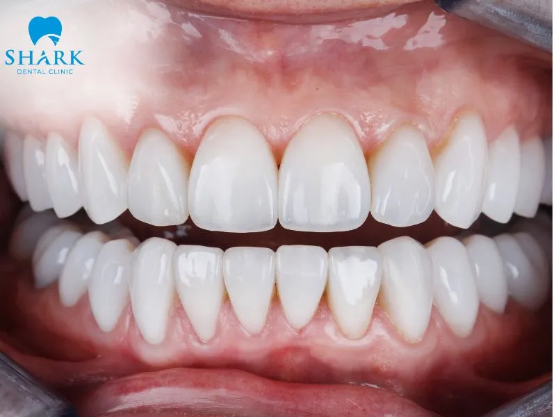 how long does it take to get used to veneers