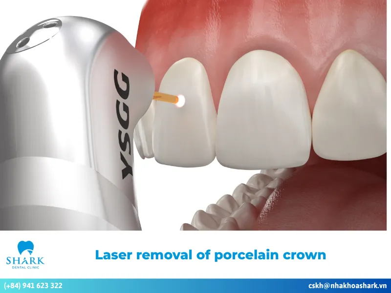 Laser removal of porcelain crowns: A major dental advancement
