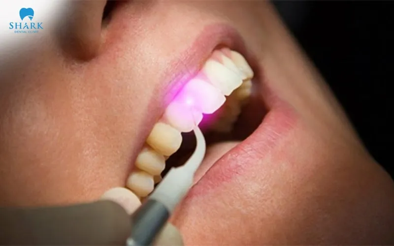 Laser removal of porcelain crowns primarily uses an Er laser with wavelengths ranging from 2,780 nm to 2,940 nm