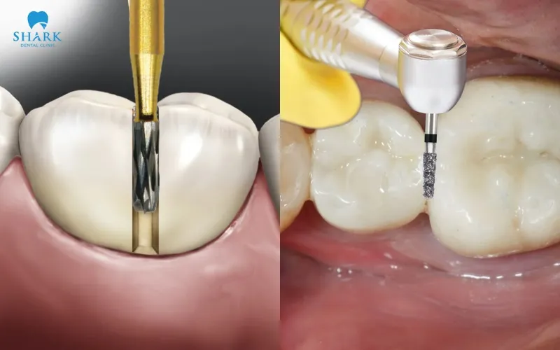 Using specialized crown-removal instruments and cutting porcelain crowns are traditional methods of removing dental crowns