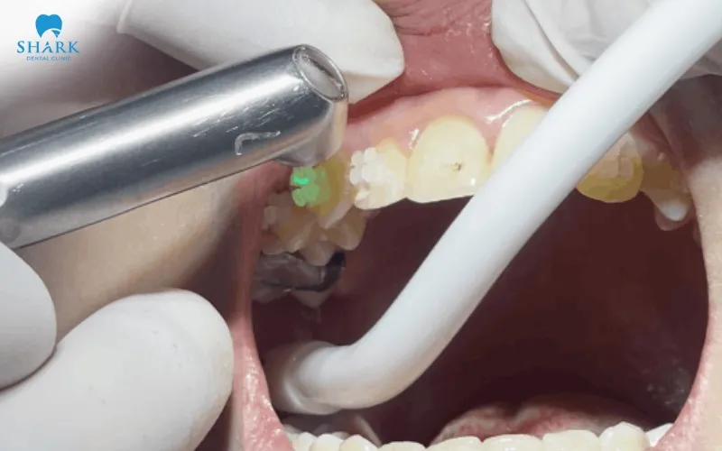 Laser removal of porcelain crowns helps shorten the procedure and improve treatment efficiency