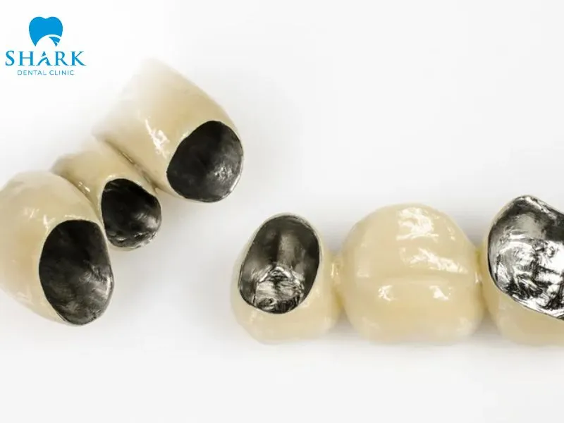 The metal alloys contained in porcelain crowns are a common cause of allergic reactions