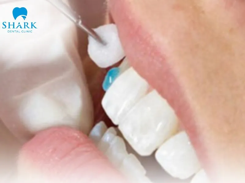 Some patients may develop an allergy to the bonding materials used during porcelain crown placement