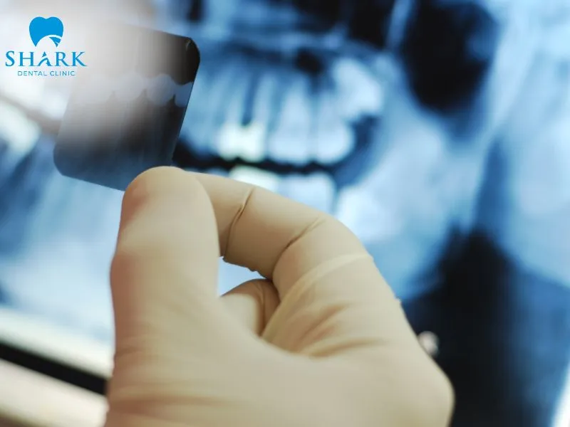 A prompt dental examination is necessary to accurately diagnose the allergic reaction