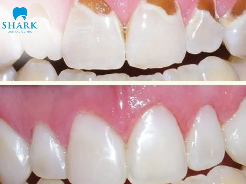 Results after cosmetic composite bonding treatment