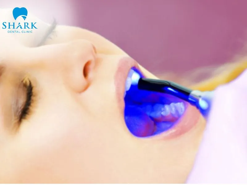 Cosmetic composite bonding is a highly popular treatment that is affordable and suitable for the budgets of most patients