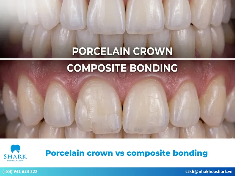 Porcelain crown vs composite bonding: What are the differences?