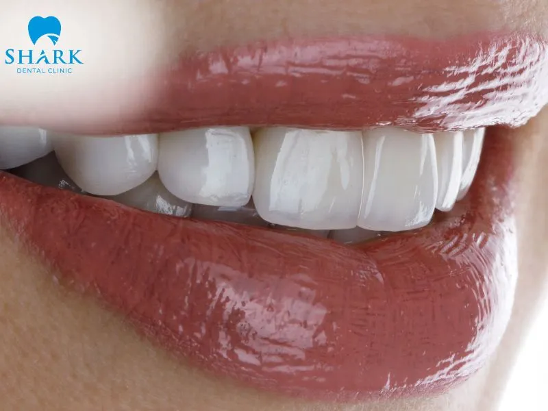 A porcelain crown covers the prepared tooth, while a porcelain inlay restores a damaged area within the tooth without covering the entire tooth.