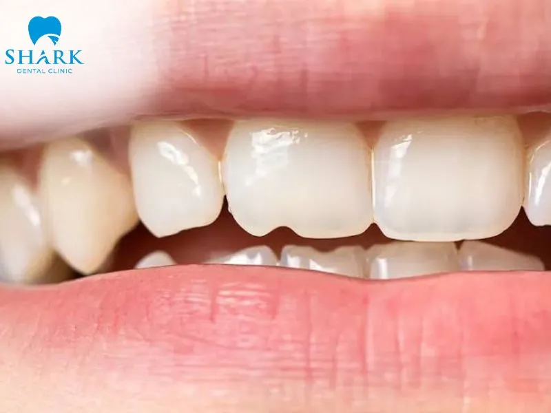 A porcelain inlay is suitable for teeth with minor chips, small fractures, or mild tooth decay