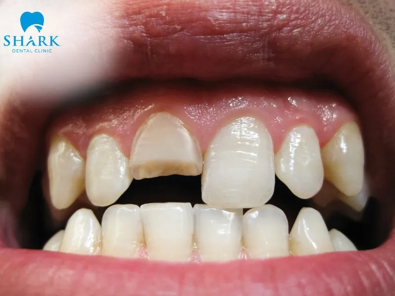A porcelain crown is suitable for teeth that are severely damaged or have previously undergone root canal treatment