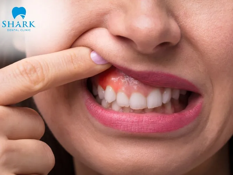 Gingivitis is one of the common signs that a dental crown may be loose or leaking