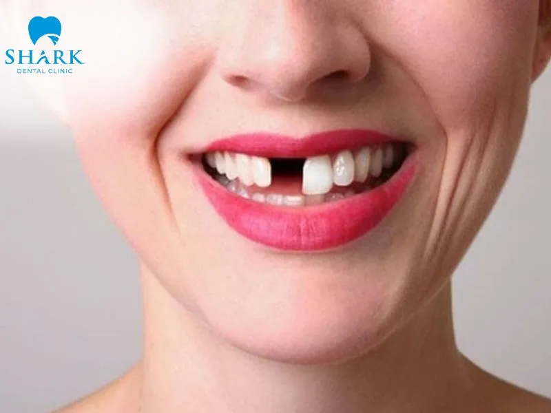 Possible complications of an exposed crown margin when the condition remains untreated