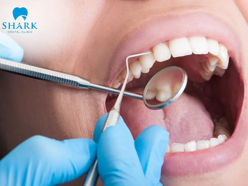 Regular dental examinations help reduce the risk of porcelain crown cement leakage