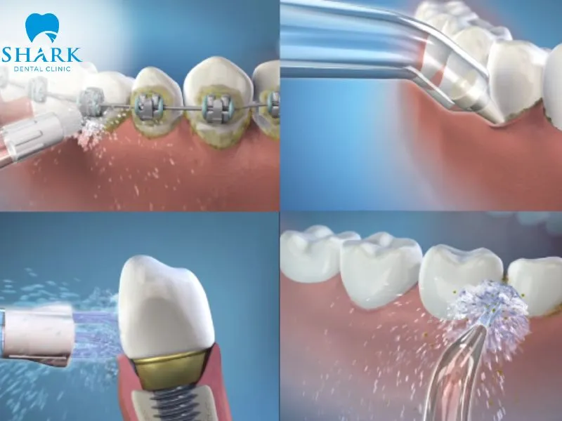 Using a water flosser with the correct technique provides effective cleaning while helping protect porcelain veneers from unnecessary surface damage during use