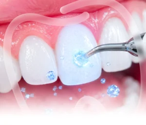 Tooth Enamel Remineralization