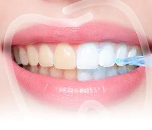 Teeth Whitening