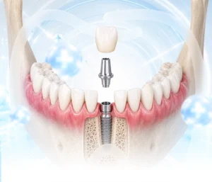 Single Implant