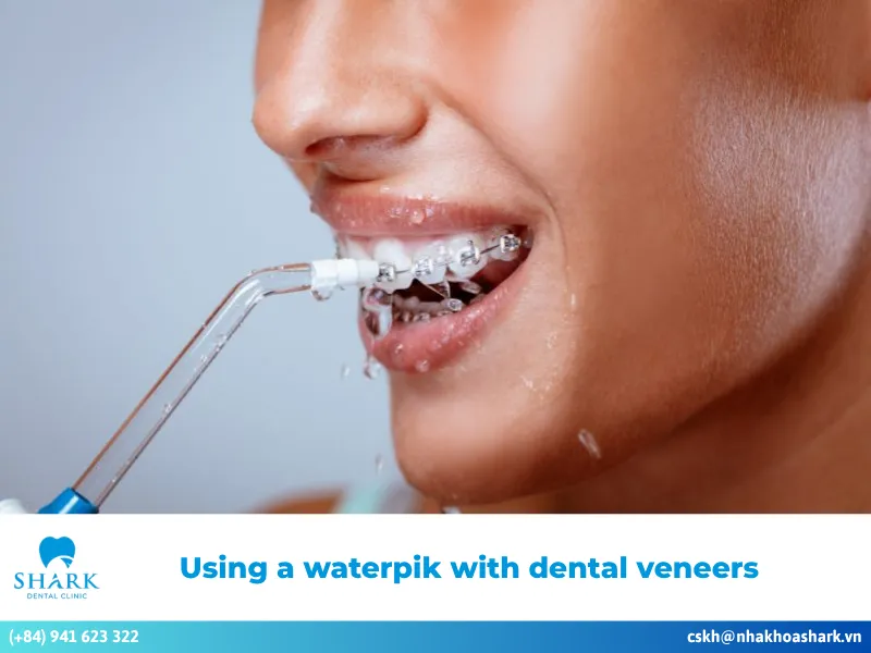 Using a waterpik with dental veneers: Benefits & safe guide