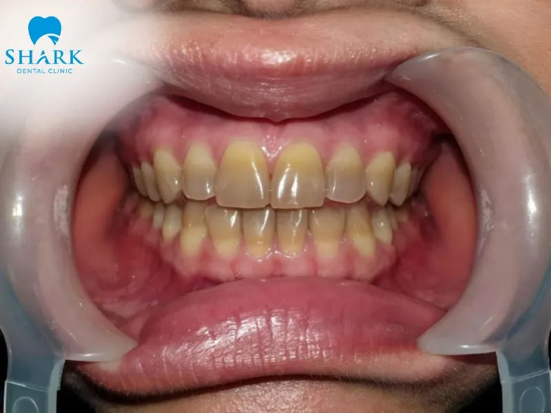 Tetracycline tooth stains can make the teeth appear unattractive and significantly affect the overall aesthetics of the smile