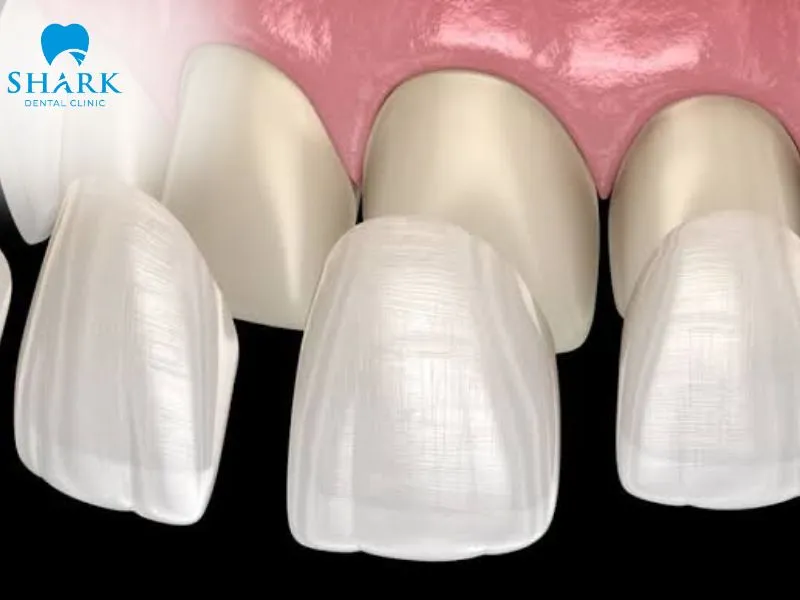 Using porcelain veneers helps preserve as much natural tooth structure as possible while minimizing the risk of pain and sensitivity