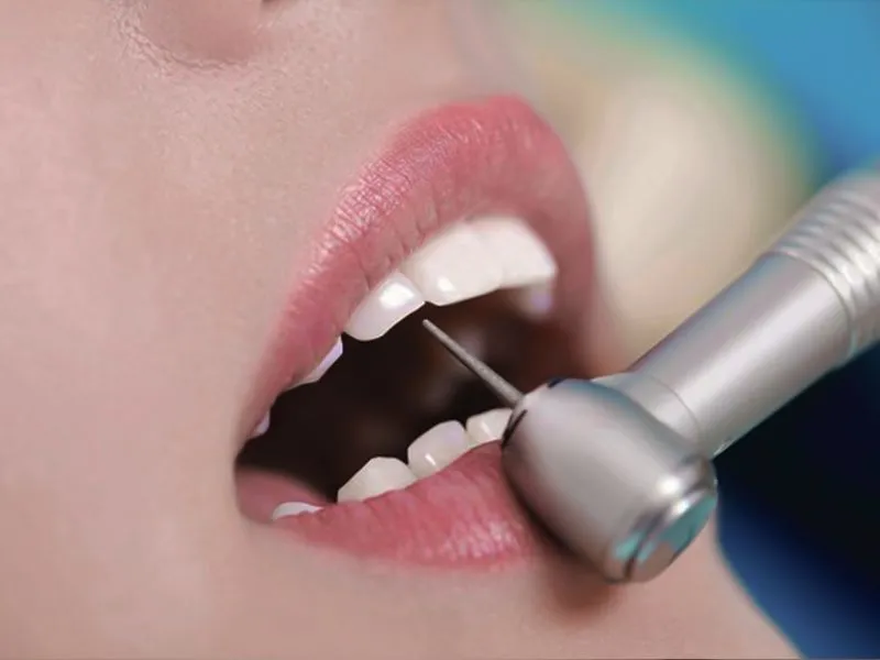 The porcelain veneer procedure is performed with great care to ensure aesthetic quality, precise placement, and maximum preservation of the natural teeth