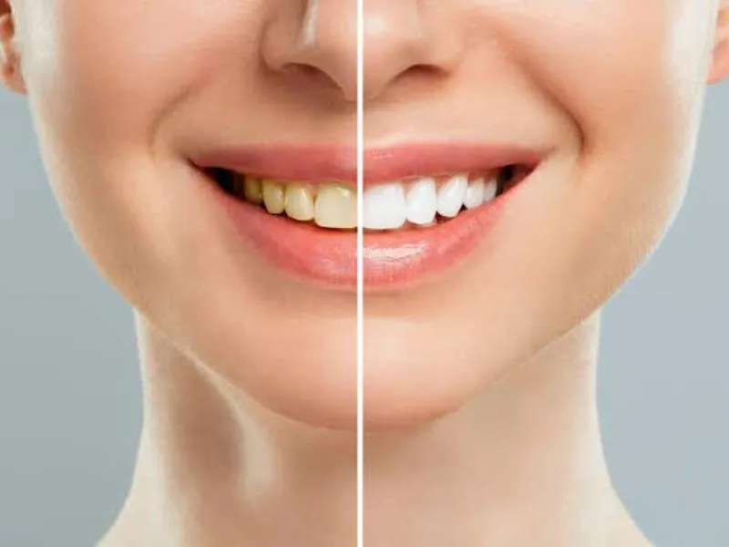 Teeth whitening helps brighten the color of the teeth without affecting the internal structure of the tooth enamel