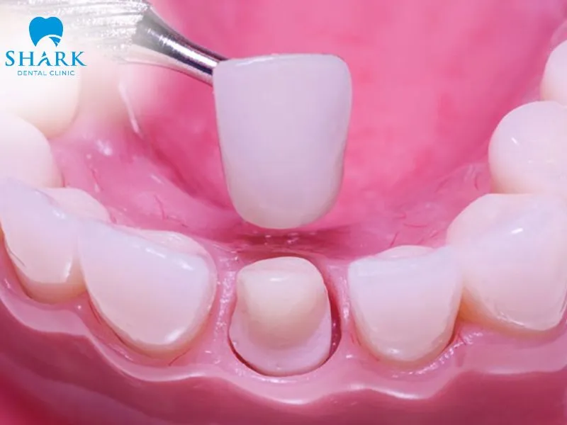 After the natural tooth is prepared, the porcelain crown is placed over the remaining tooth structure to restore its shape and function