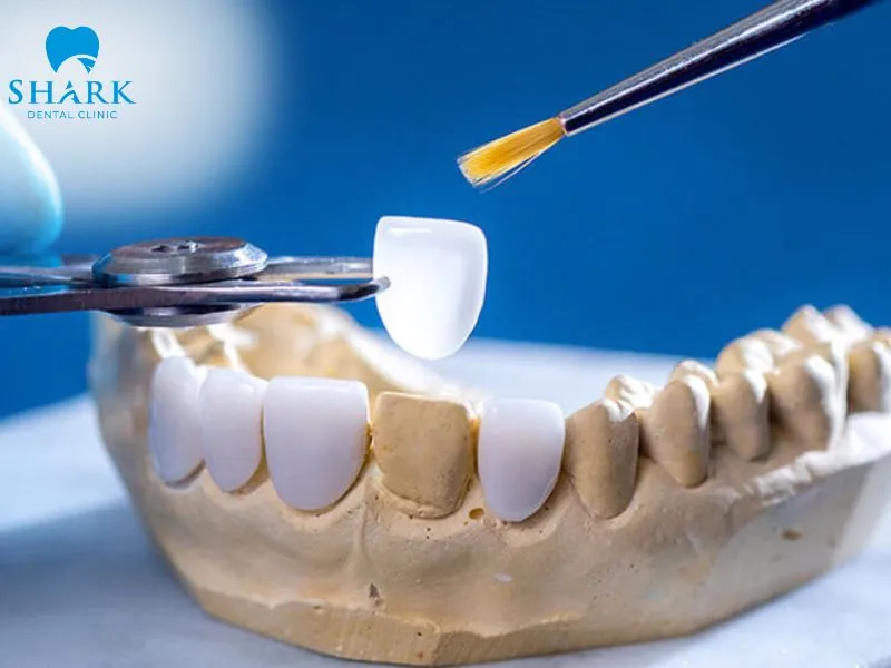 Porcelain veneers help effectively improve the appearance of dull, yellow, or discolored teeth