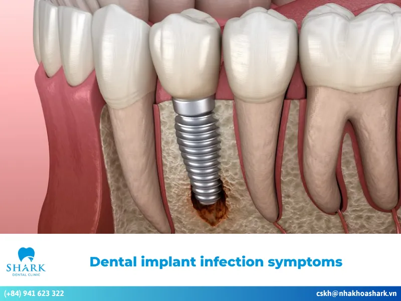 Dental implant infection symptoms and their causes