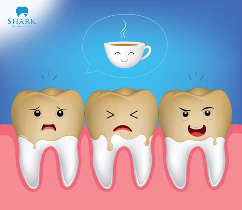There are several causes of porcelain veneer discoloration, among which lifestyle habits and dietary choices are important contributing factors