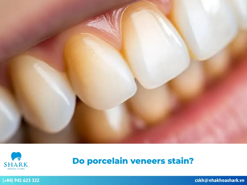 Do porcelain veneers stain? Best care tips for a bright smile