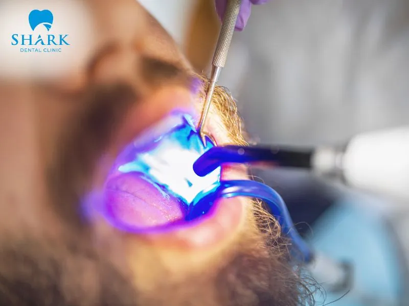 Depending on the specific case, the dentist will determine whether drilling is required before placing a filling