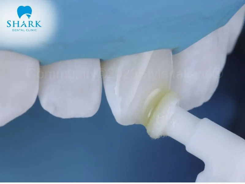 Icon technology helps to treat early-stage tooth decay and helps arrest the progression of selected early, non-cavitated enamel lesions