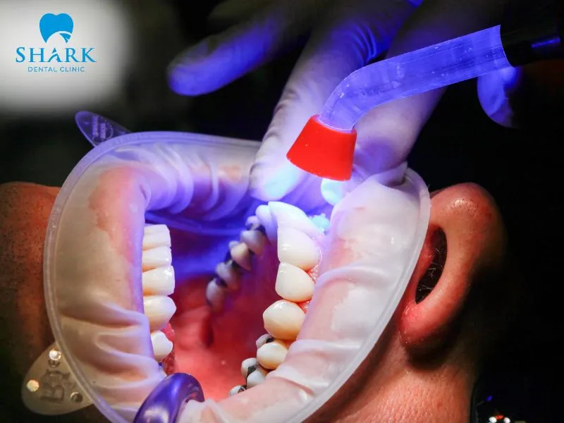 The drill-free filling procedure takes place quickly, safely, and with minimal invasiveness