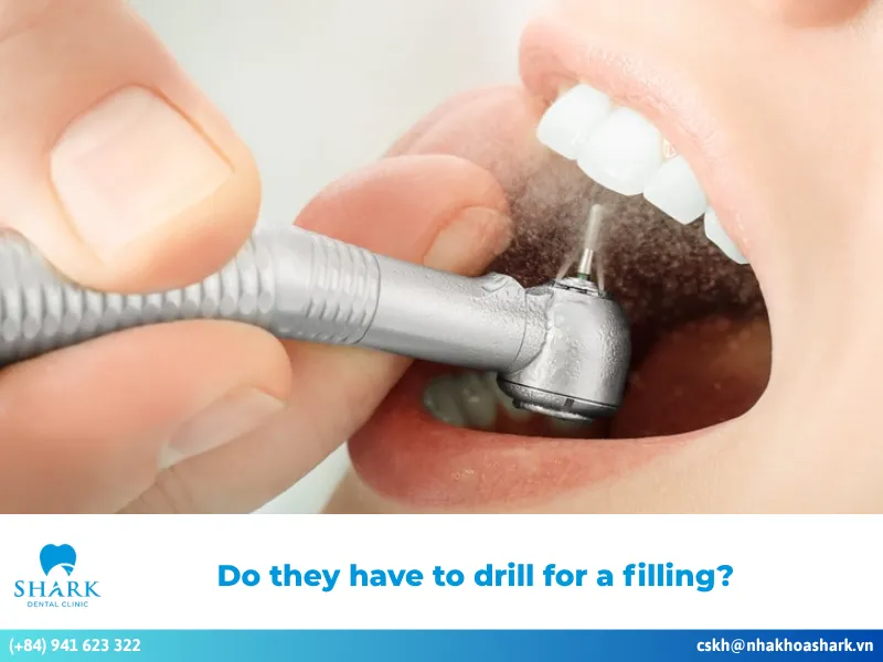 Do they have to drill for a filling? When it is necessary