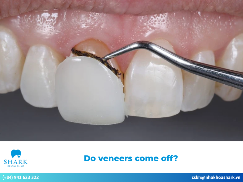 Do veneers come off? Can a loose veneer harm your teeth?