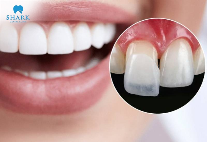 There are many different signs that can help you recognize when a veneer has come loose and is affecting the tooth