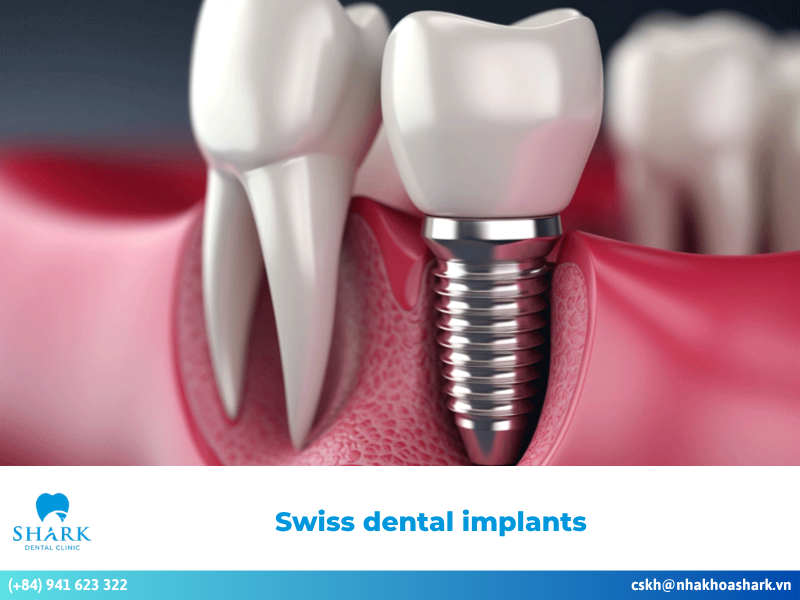 Swiss dental implants: Advanced implant solutions & benefits