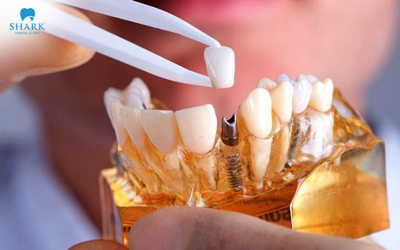 Once the implant has fully and securely integrated, the dentist attaches the abutment and the porcelain crown in order to complete the tooth