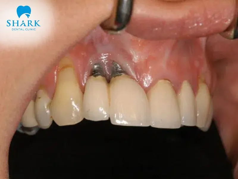 An implant infection is a complication that can affect both the integration of the post and the success of the restoration