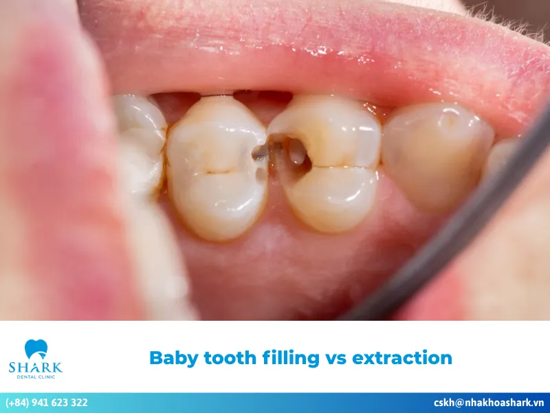 Baby tooth filling vs extraction: Which is better for your child?