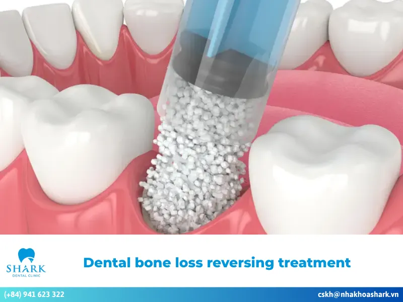 Discover safe dental bone loss reversing treatment options