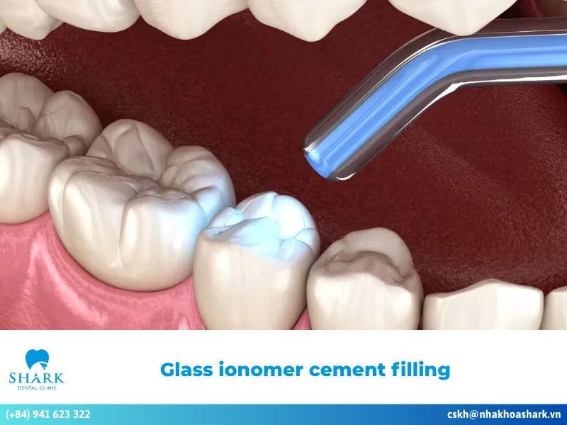 Glass ionomer cement filling: Important facts you should know